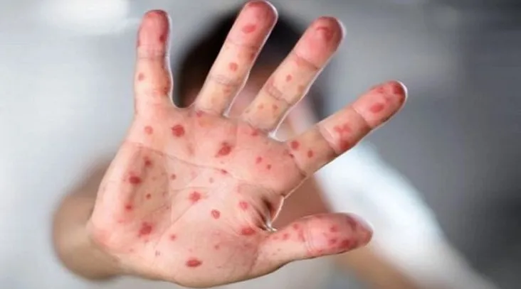 ২৪ ঘণ্টায় হামের উপসর্গে আরও ৫ শিশুর মৃত্যু  